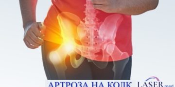 Артроза на колк (коксартроза): симптоми, причини, лекување и улогата на физикалната терапија